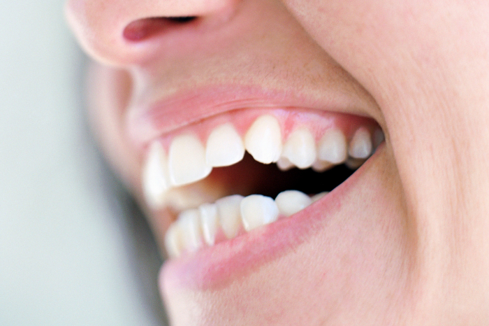 Teeth whitening and veneers | Preferred Family Dental | Dentists in Bedford, NH
